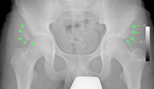 Anterior Inferior Iliac Spine Avulsion Fracture Faqs Hip And Pelvis